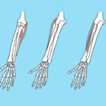 中手骨に付着する筋肉